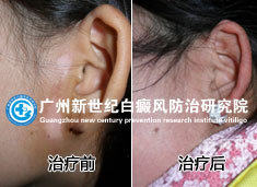 王先生 25岁 颈部白癜风