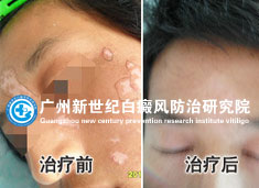 管同学 21岁 面部白癜风