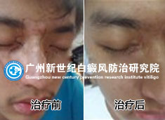 吴同学 18岁 面部白癜风