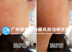 孙小姐 24岁 下巴部白癜风