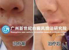 闲同学 18岁 唇部白癜风