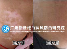 王先生 25岁 颈部白癜风