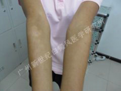 ˫��ǰ��ɢ�ڰװ߼�ɫ