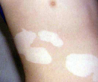 Ò©ÎïÐÔ°×ñ°·ç