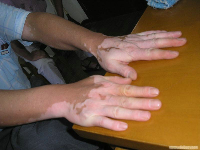 ����Ƥ��