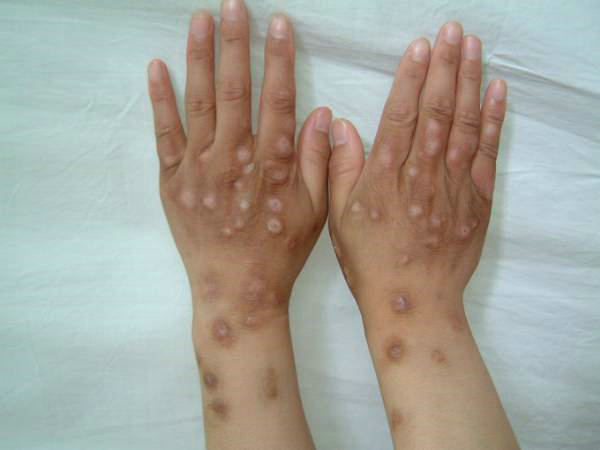 白癜风典型损害