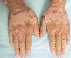 白癜风症状特征