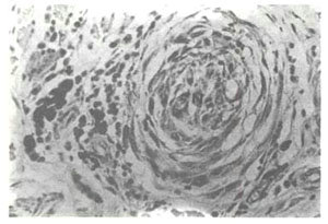 影响白癜风黑色素合成的因素有哪些?