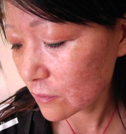 面部白癜风会带来哪些心理负担?