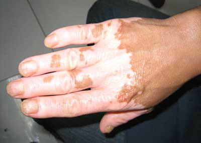 导致白癜风的八大因素究竟是哪些?