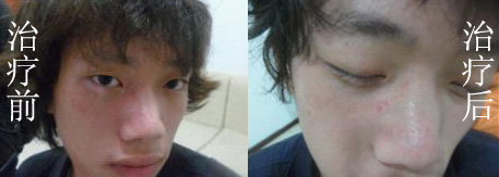 患有白癜风疾病怎样治