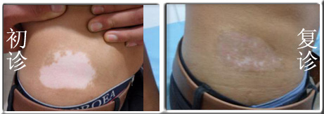 白癜风怎样治疗