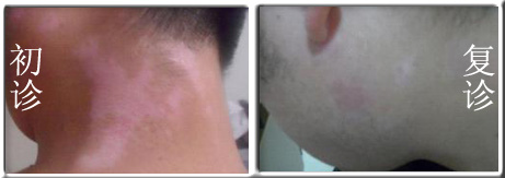 广州白癜风有的治疗吗