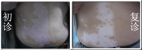 皮肤白斑是什么原因及治疗