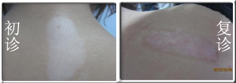 如何治疗白殿风病